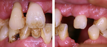 歯周病症例1-1