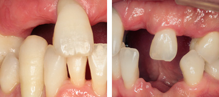 歯周病症例1-2