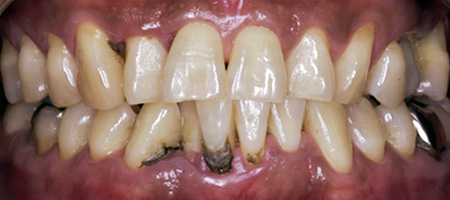 歯周病症例2-1