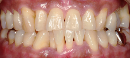 歯周病症例2-2