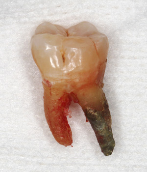 歯周病症例3
